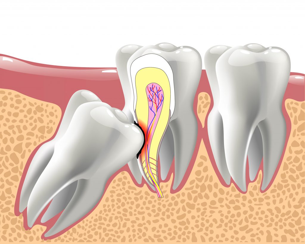 Why Your Wisdom Teeth Need The Boot Destination Dental